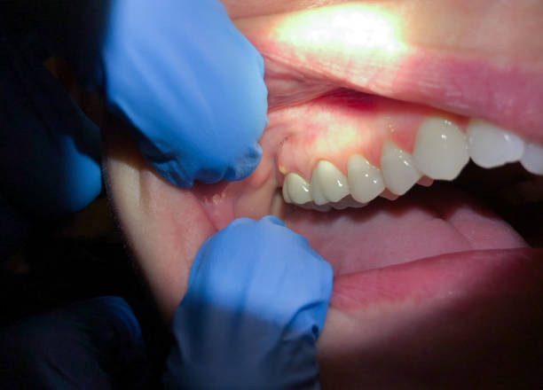 Best Emergency Dentist for Knocked-Out Tooth in Coeburn, VA